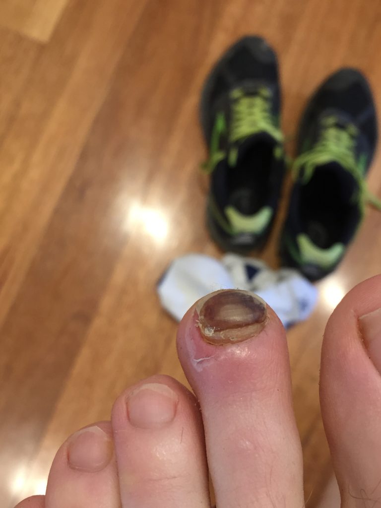 runner's toe, black toenail from running