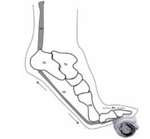 Plantar Fasciitis, Running Foot Pain