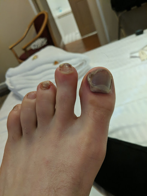 Runners toe, black toe nails, ultra trail australia