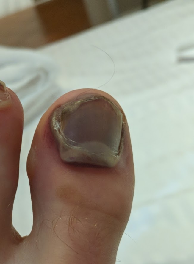runner's toe, black toenail when running
